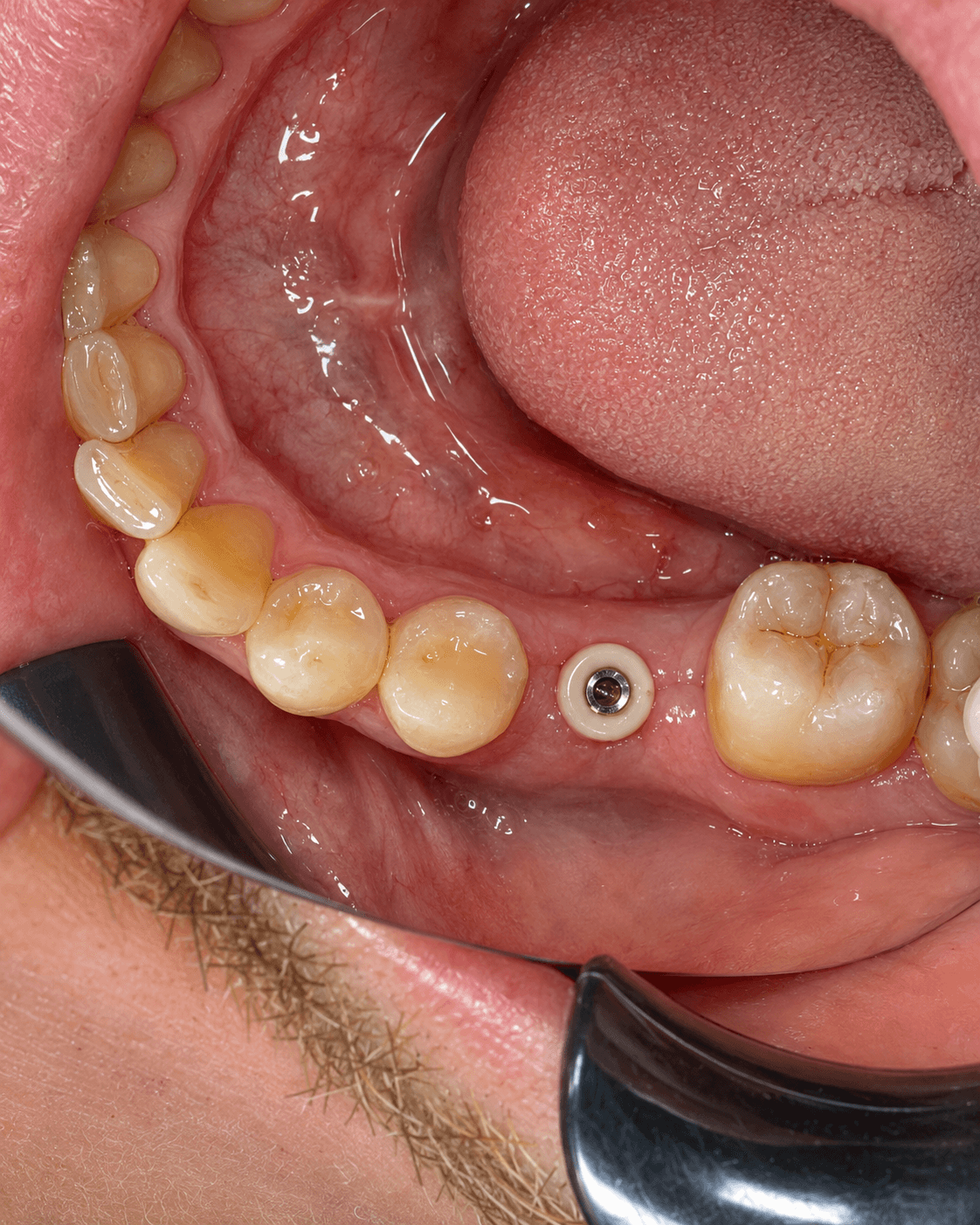 Dental Implants