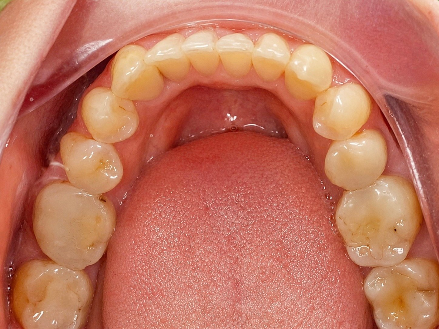 Clear Aligner after treatment at FLOSS Dental Studio