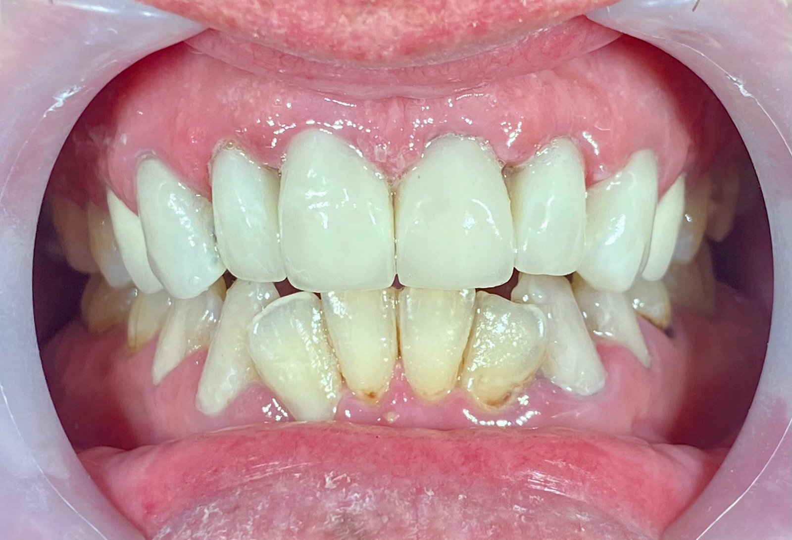 Smile Makeover after treatment at FLOSS Dental Studio