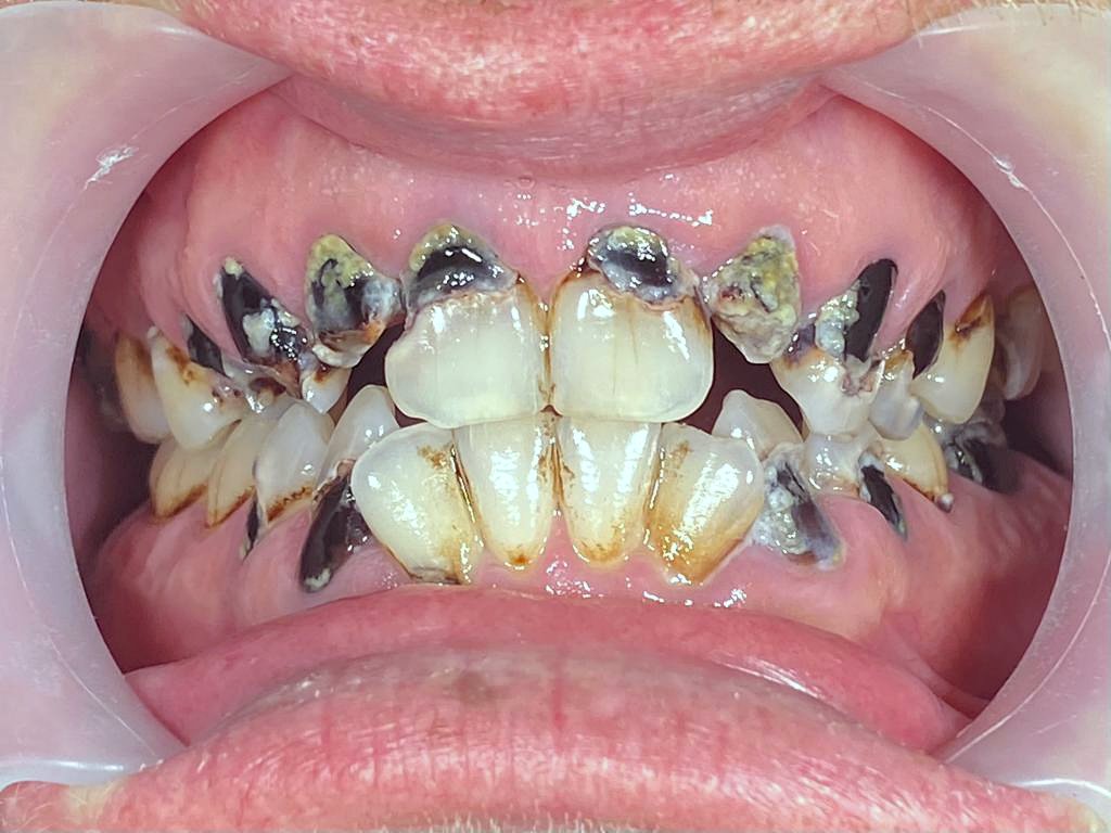 Smile Makeover before treatment at FLOSS Dental Studio