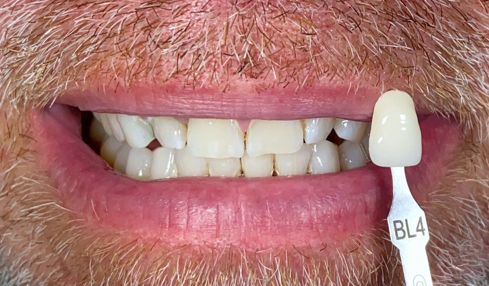 Hasil setelah Teeth Whitening di FLOSS Dental Studio