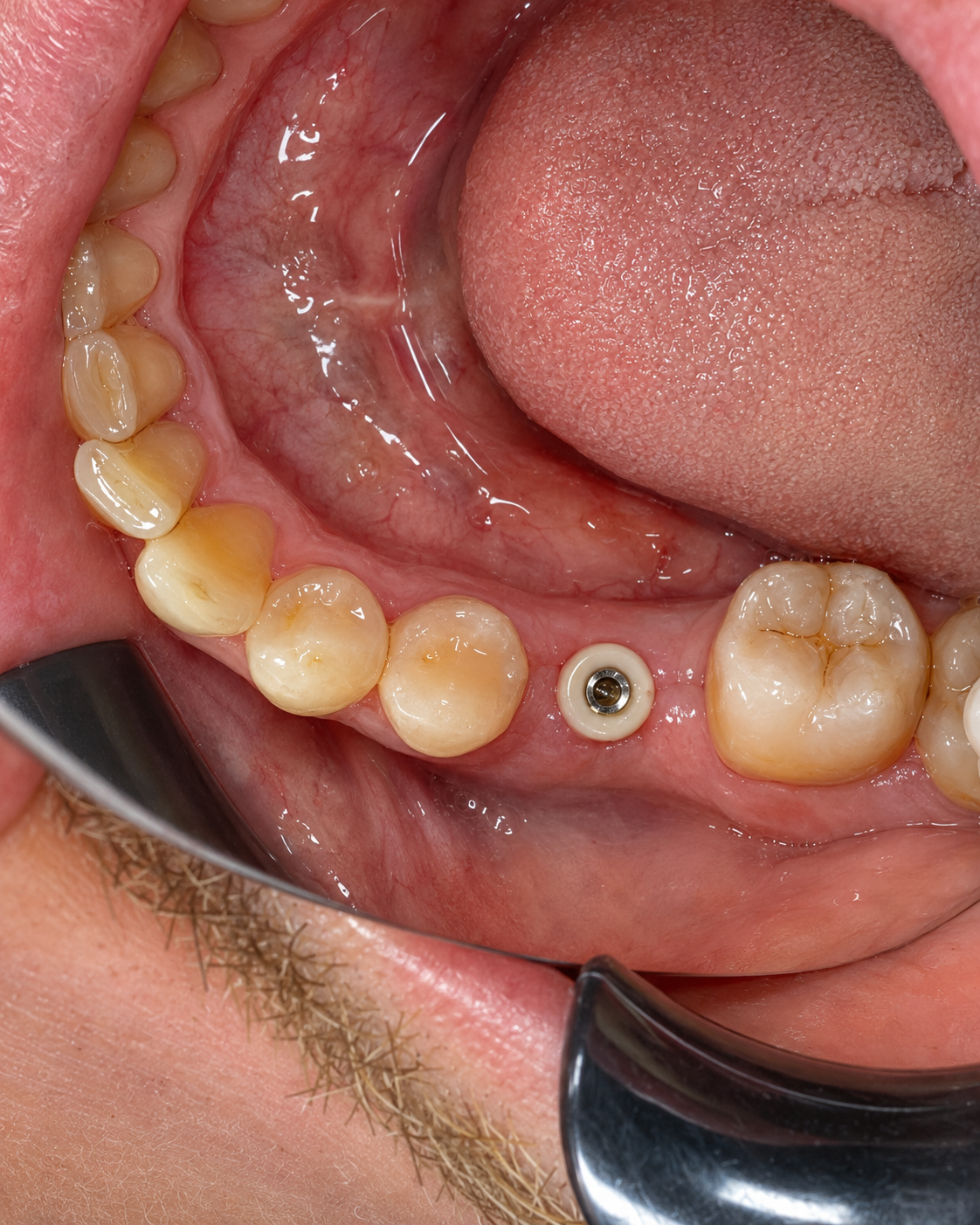 Dental implant treatment at FLOSS Dental Studio